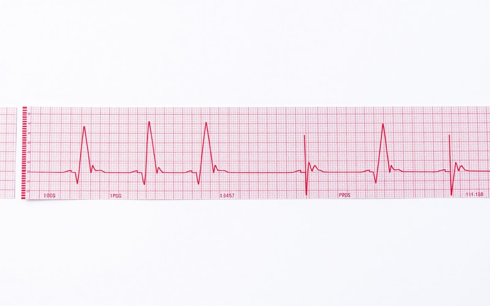 12-lead ECG strip on grid paper